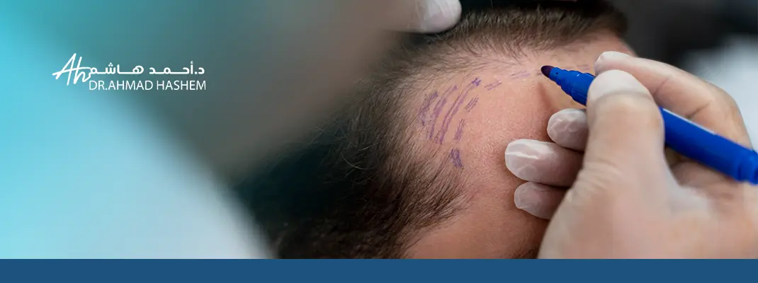 علاج الصلع عند النساء