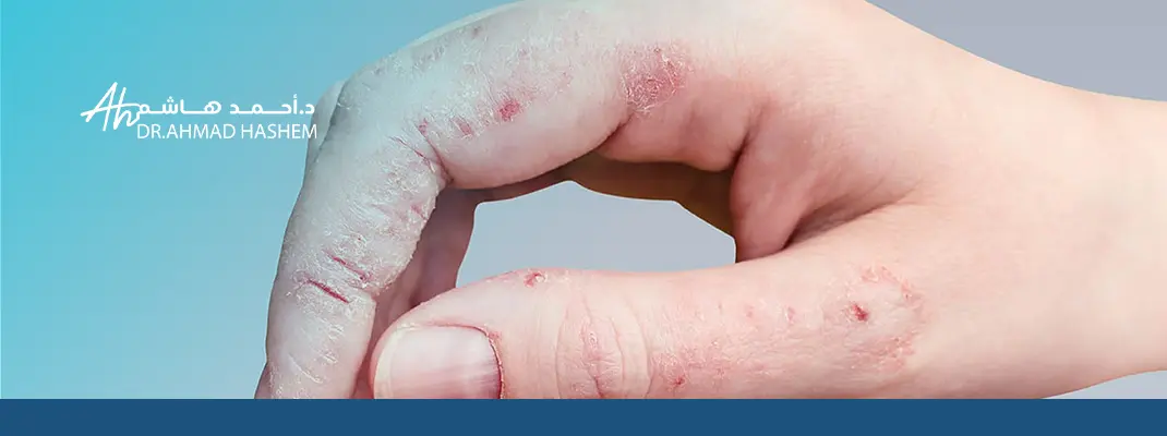 علاج الفطريات والحكه