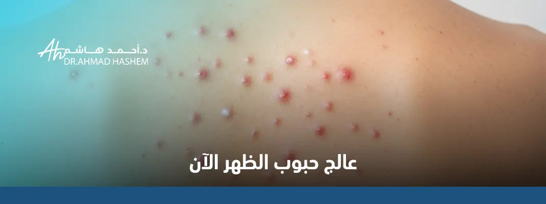 علاج حبوب الظهر والكتف تجربتي