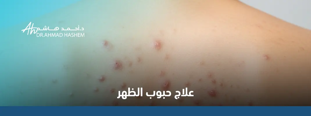علاج حبوب الظهر