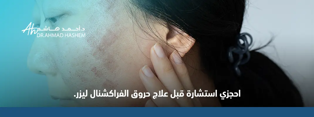 علاج حروق الفراكشنال ليزر
