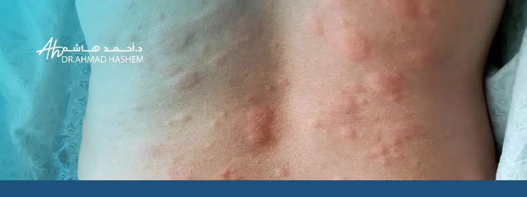 علاج حساسية الجلد المفاجئة