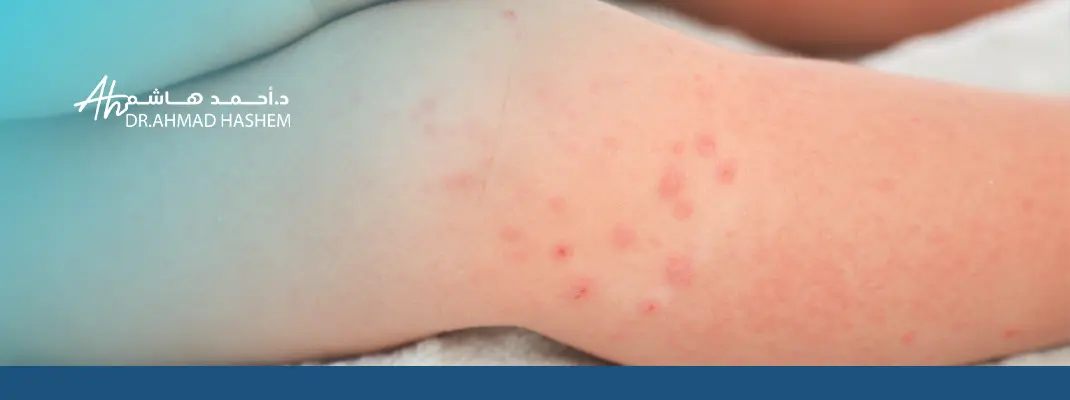 علاج حساسية الجلد وانواعها بالصور