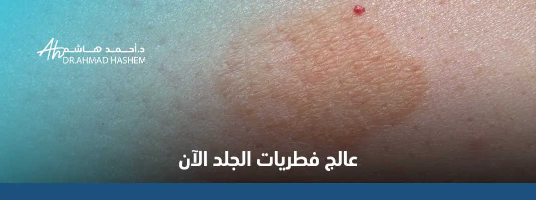 علاج فطريات الجلد بالصور