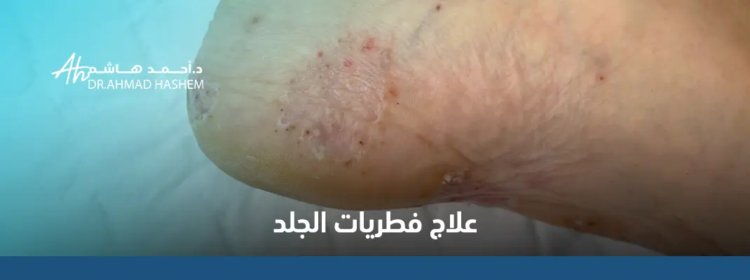 علاج-فطريات-الجلد.webp