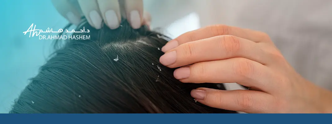 علاج قشرة الرأس والحكة