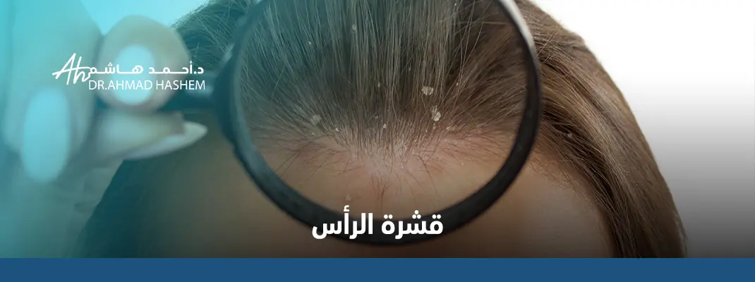 قشرة-الرأس.webp