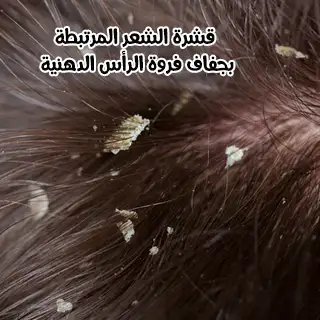 قشرة الشعر المرتبطة بجفاف فروة الرأس الدهنية