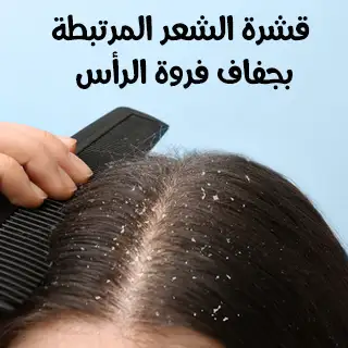 قشرة الشعر المرتبطة بجفاف فروة الرأس
