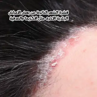 قشرة الشعر الناتجة عن بعض الأمراض الجلدية الأخرى مثل الاكزيما والصدفية