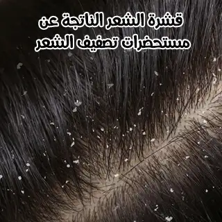 قشرة الشعر الناتجة عن مستحضرات تصفيف الشعر