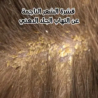 قشرة الشعر الناجمة عن التهاب الجلد الدهني