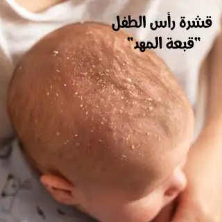 قشرة رأس الطفل