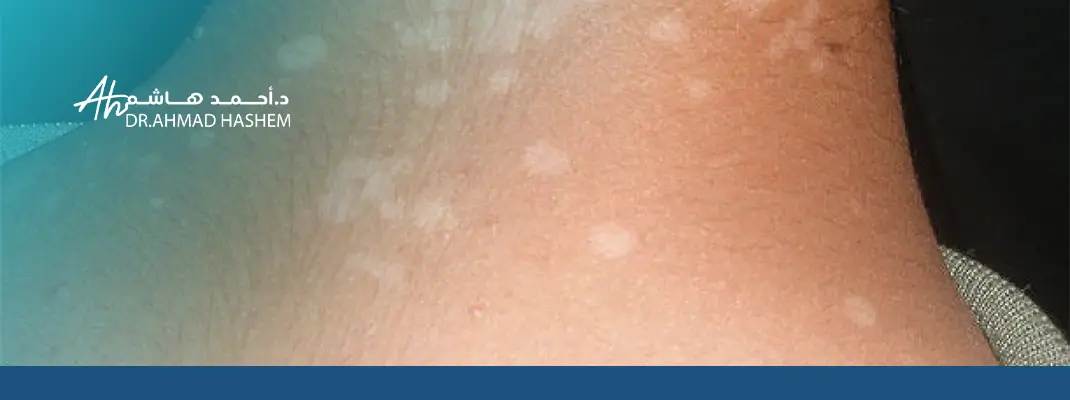 هل مرض التينيا خطير