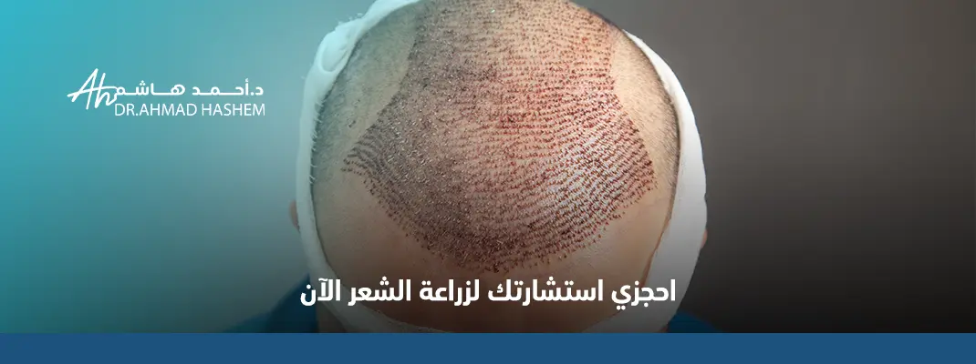 زراعة شعر جدة