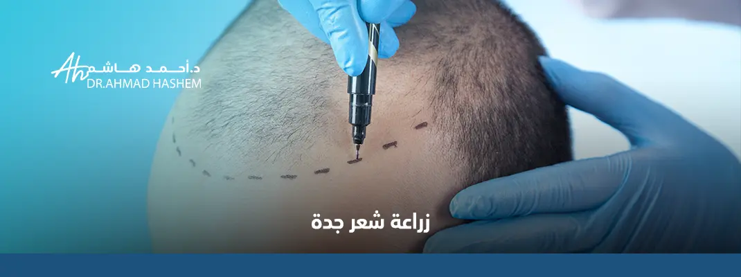 زراعة شعر جدة