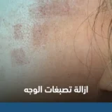 ازالة تصبغات الوجه