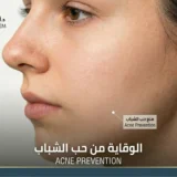 الوقاية من حب الشباب