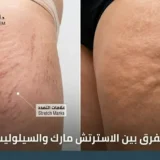 الفرق بين الاسترتش مارك والسيلوليت
