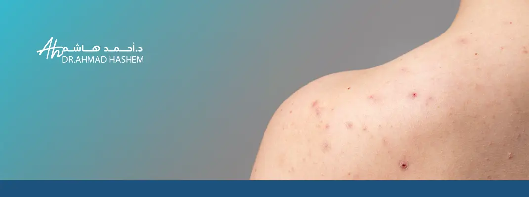 انواع الحبوب في الجسم مع الصور