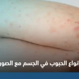 انواع الحبوب في الجسم بالصور