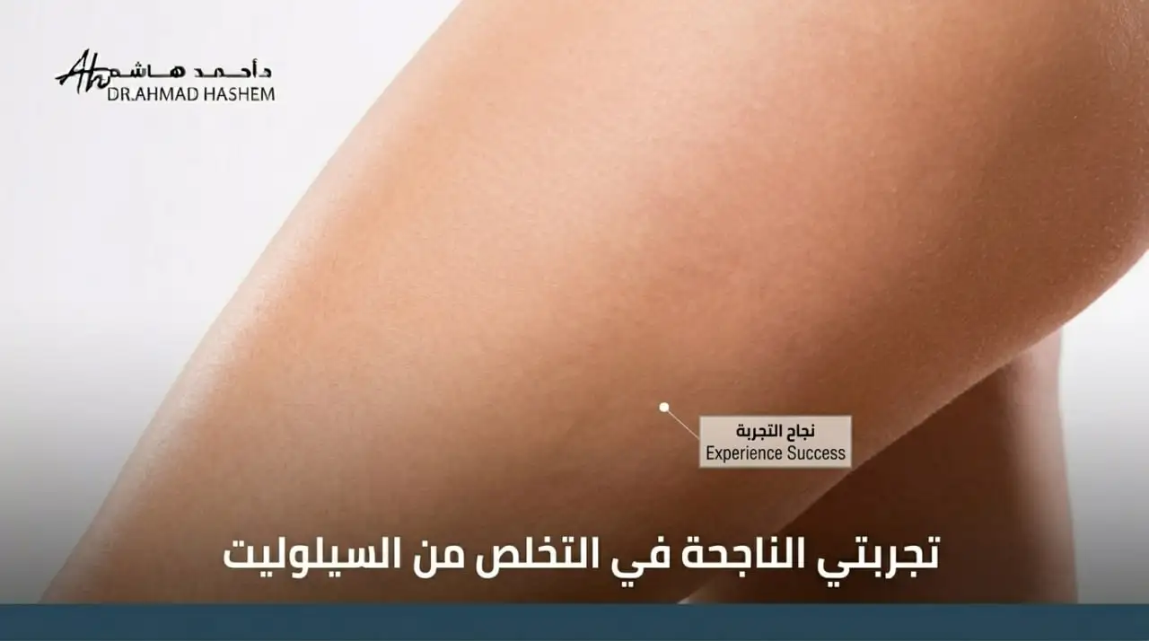 تجربتي الناجحة في التخلص من السيلوليت