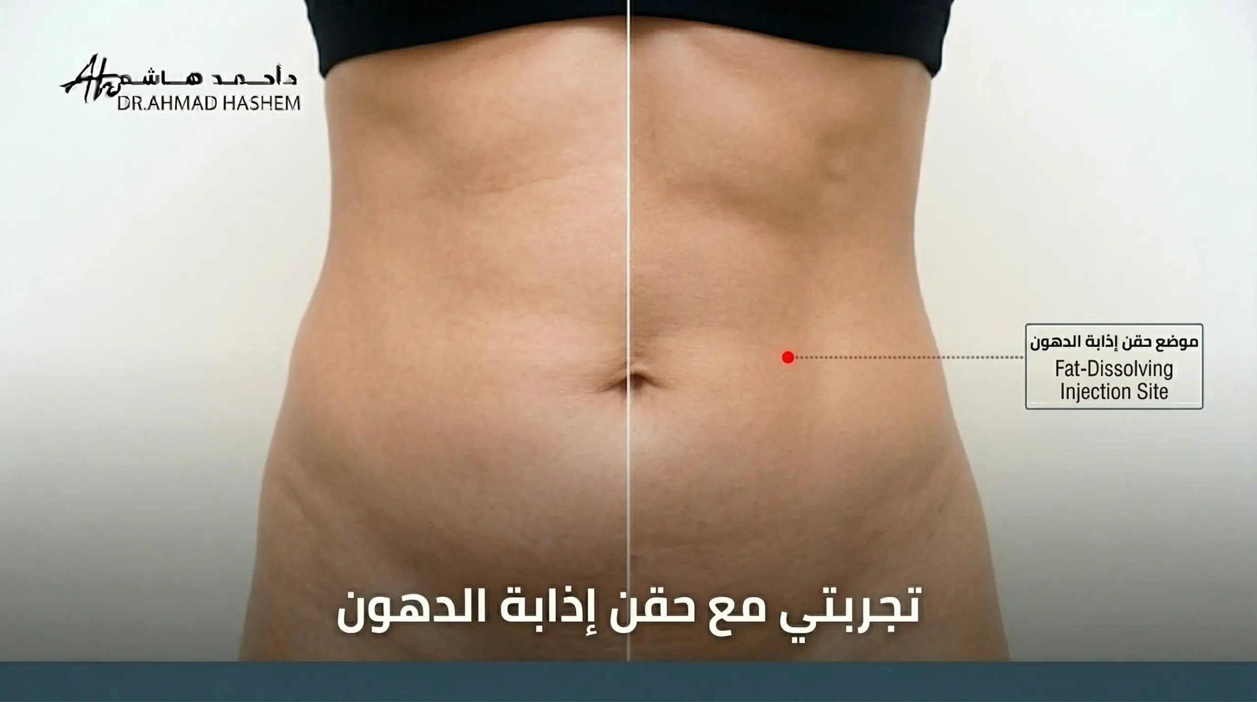 تجربتي مع إبر إذابة الدهون