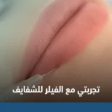 تجربتي مع فيلر الشفايف