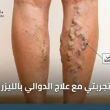 تجربتي مع علاج الدوالي بالليزر