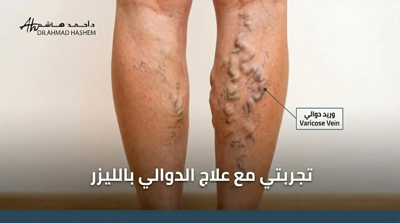 تجربتي مع علاج الدوالي بالليزر