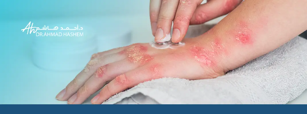علاج حساسية الجلد