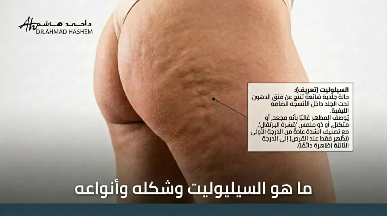 ما هو السيلوليت وشكله وأنواعه