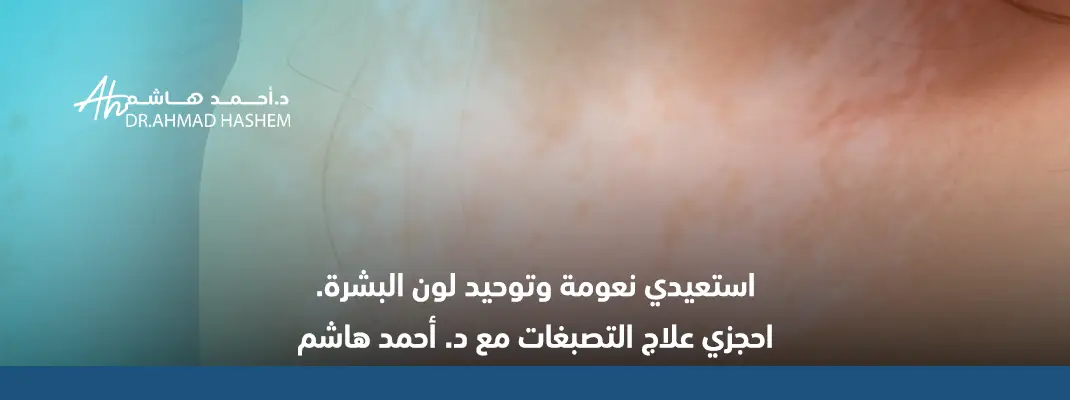 علاج تصبغات المناطق الحساسة في جدة