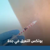 بوتكس التعرق في جدة