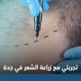 تجربتي مع زراعة الشعر في جدة