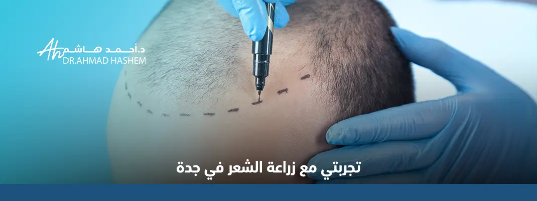 تجربتي مع زراعة الشعر في جدة