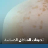علاج تصبغات المناطق الحساسة