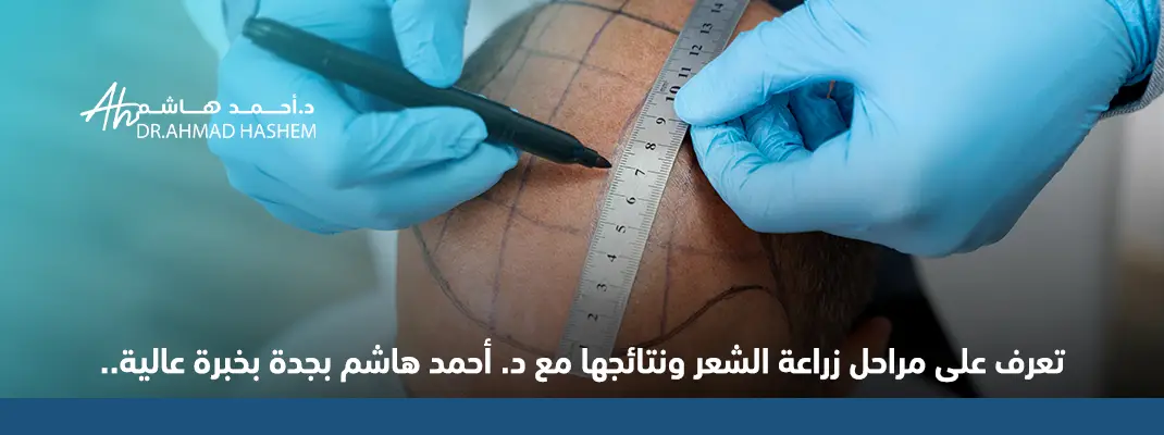 تعرف على مراحل زراعة الشعر ونتائجها مع د. أحمد هاشم بجدة بخبرة عالية