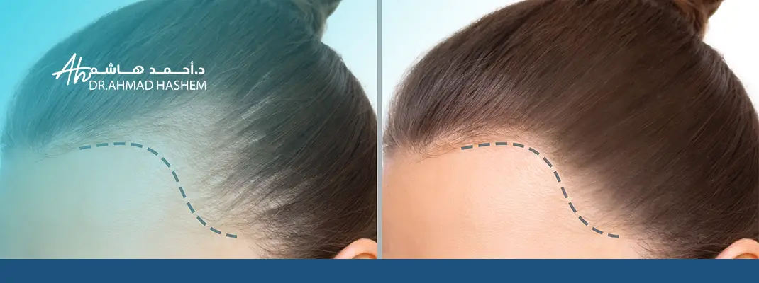 تعرف على مراحل زراعة الشعر ونتائجها مع د. أحمد هاشم بجدة بخبرة عالية