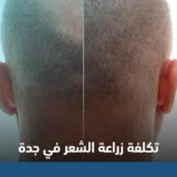 تكلفة زراعة الشعر في جدة