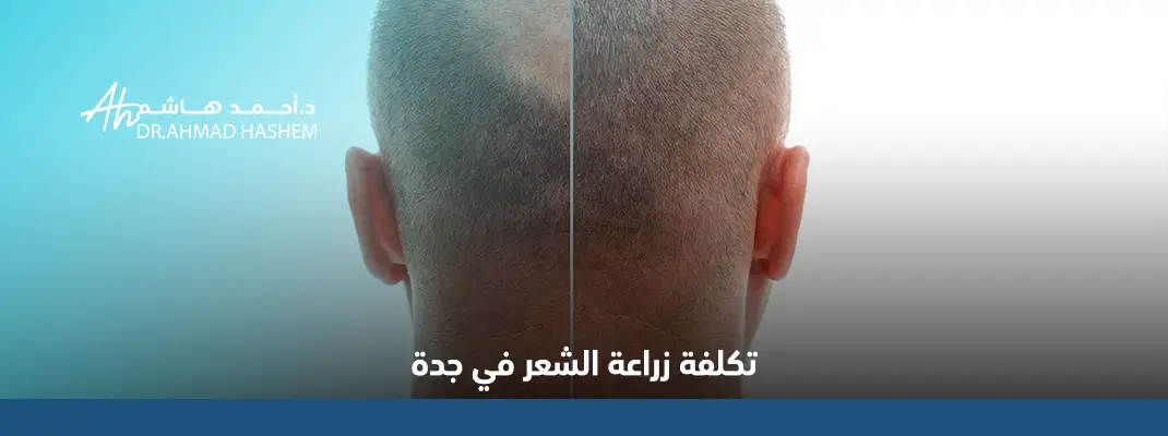 تكلفة زراعة الشعر في جدة