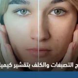 علاج التصبغات والكلف بتقشير كيميائي
