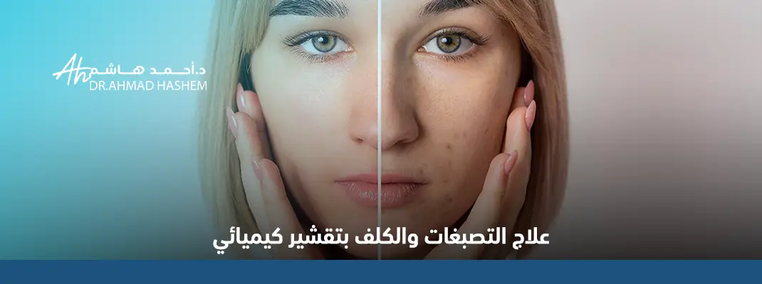 علاج التصبغات والكلف بتقشير كيميائي