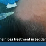 hair loss treatment in Jeddah