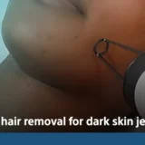 laser hair removal for dark skin jeddah