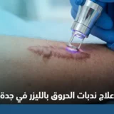 علاج ندبات الحروق بالليزر في جدة